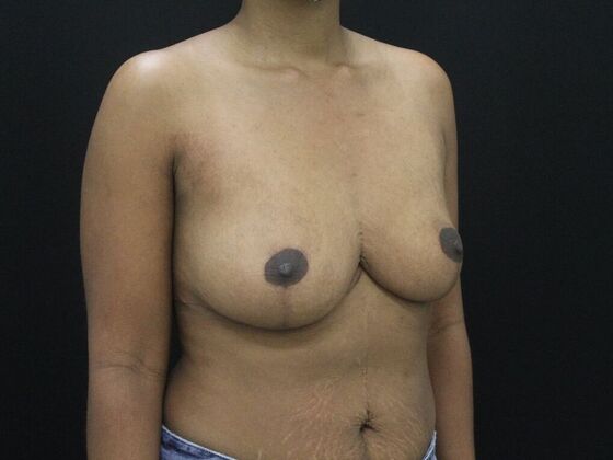 Breast Reduction & Lift: Case 12 - After