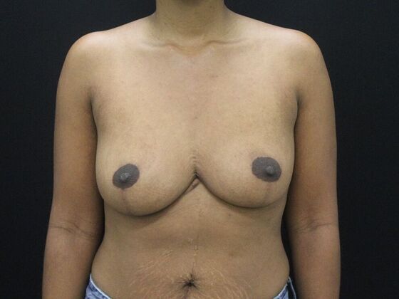 Breast Reduction & Lift Case 12 - After