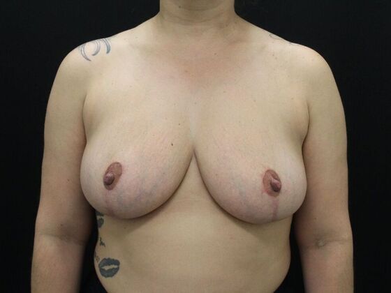 Breast Reduction & Lift Case 13 - After