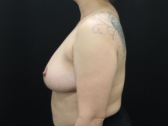 Breast Reduction & Lift: Case 13 - After