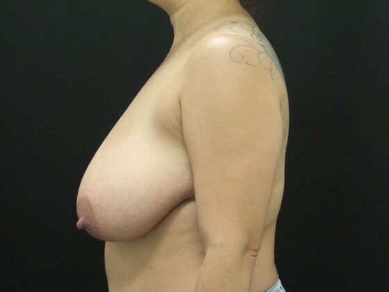 Breast Reduction & Lift: Case 13 - Before