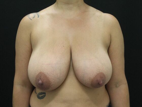 Breast Reduction & Lift Case 13 - Before