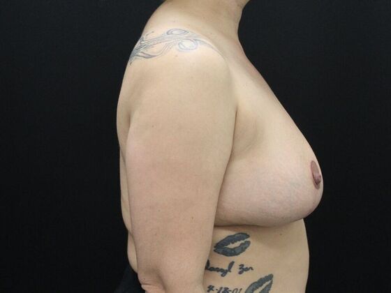 Breast Reduction & Lift: Case 13 - After