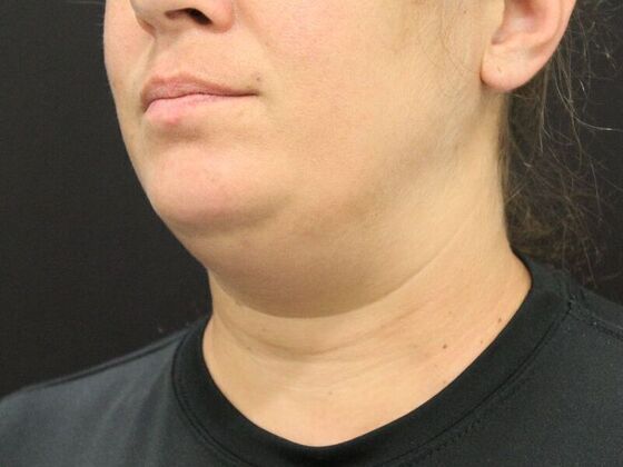 Liposuction Case 27 - Before