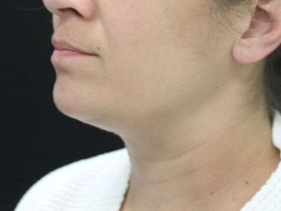 Liposuction Case 27 - After