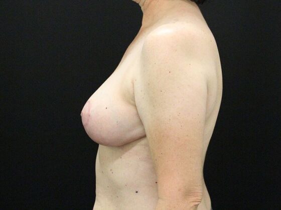 Breast Reduction & Lift: Case 14 - After