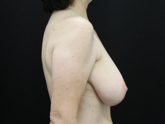 Breast Reduction & Lift: Case 14 - Before