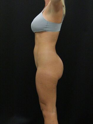 Brazilian Butt Lift: Case 8 - Before