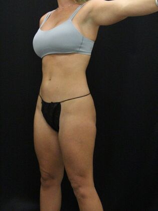 Brazilian Butt Lift: Case 8 - Before