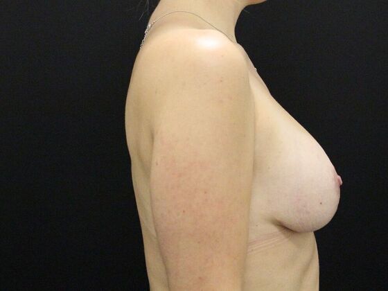 Breast Revision: Case 4 - After