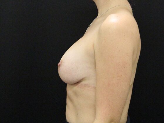 Breast Lift & Breast Lift Augmentation: Case 23 - After