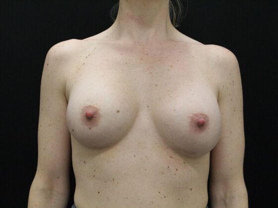 Breast Augmentation Case 21 - After