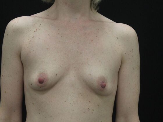 Breast Augmentation Case 21 - Before