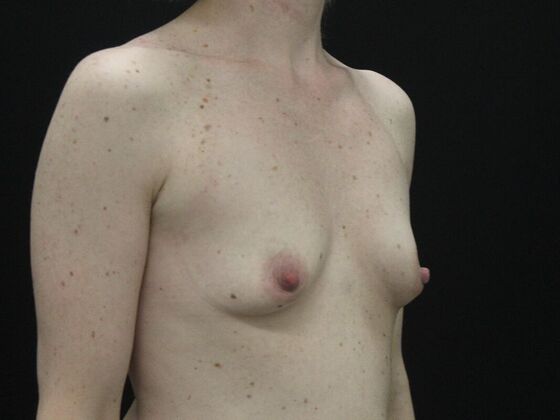 Breast Augmentation: Case 21 - Before