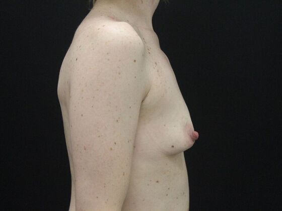 Breast Augmentation: Case 21 - Before