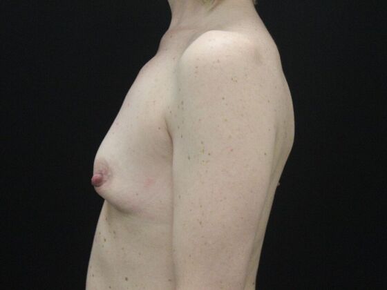 Breast Augmentation: Case 21 - Before