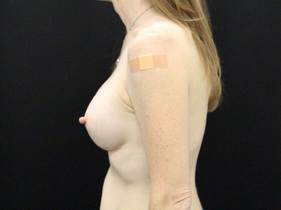 Breast Augmentation: Case 22 - After