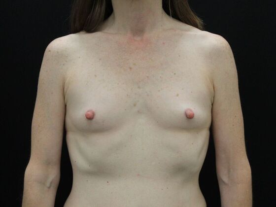 Breast Augmentation Case 22 - Before
