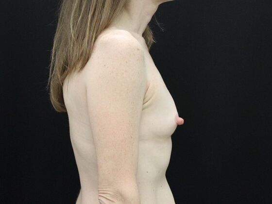 Breast Augmentation: Case 22 - Before