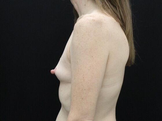 Breast Augmentation: Case 22 - Before