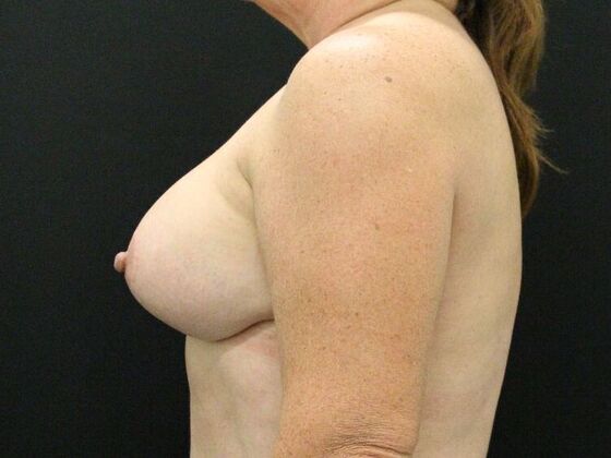 Breast Lift & Breast Lift Augmentation: Case 26 - After