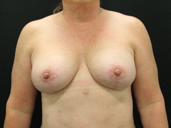 Breast Lift & Breast Lift Augmentation Case 26 - After