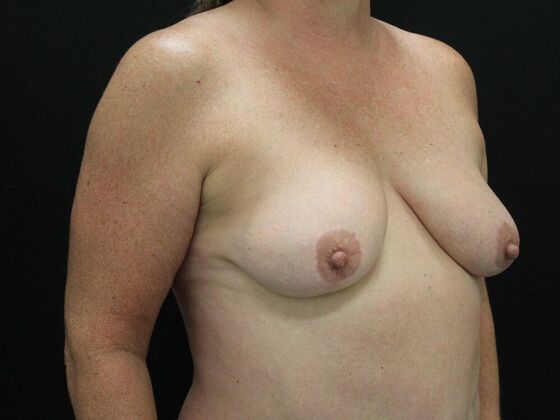 Breast Lift & Breast Lift Augmentation: Case 26 - Before