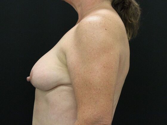 Breast Lift & Breast Lift Augmentation: Case 26 - Before