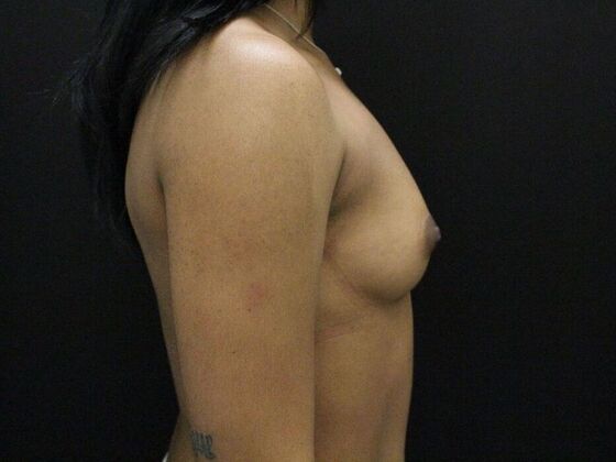 Breast Augmentation: Case 23 - Before