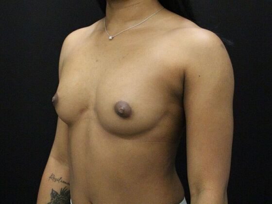 Breast Augmentation: Case 23 - Before