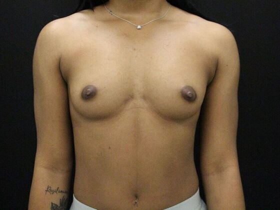 Breast Augmentation Case 23 - Before