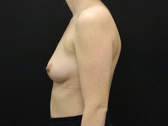 Breast Augmentation: Case 24 - Before