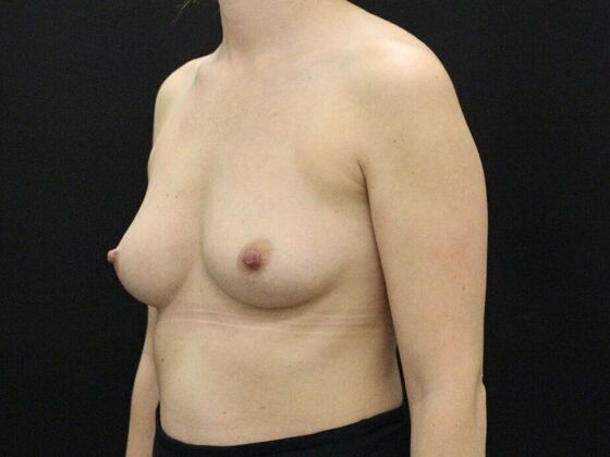 Breast Augmentation: Case 24 - Before
