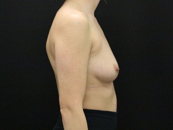 Breast Augmentation: Case 24 - Before