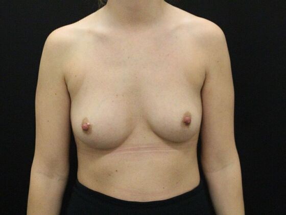 Breast Augmentation Case 24 - Before