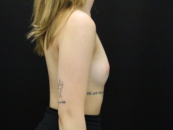 Breast Augmentation: Case 25 - Before