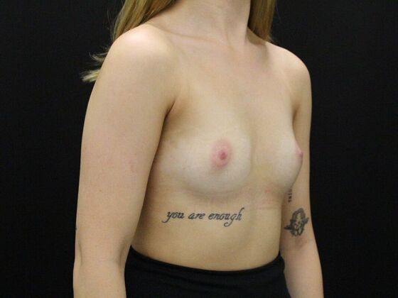 Breast Augmentation: Case 25 - Before