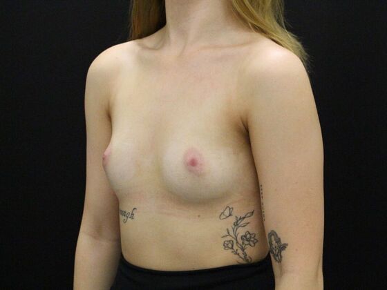 Breast Augmentation: Case 25 - Before