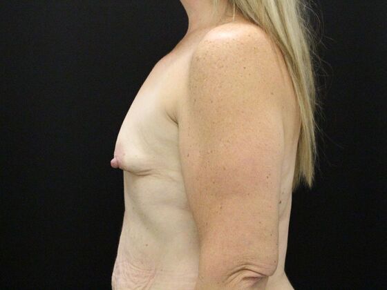 Breast Augmentation: Case 26 - Before