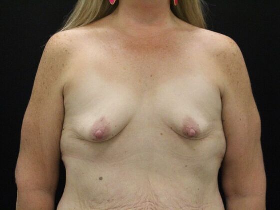 Breast Augmentation Case 26 - Before