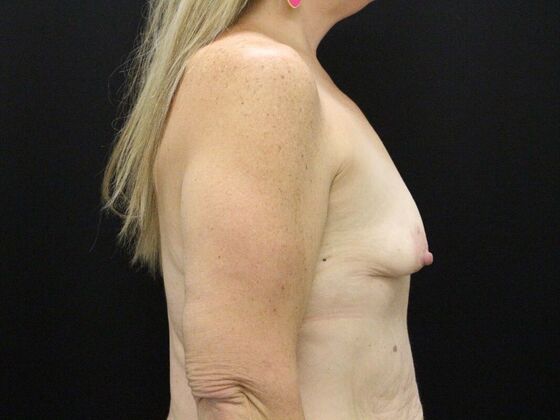 Breast Augmentation: Case 26 - Before
