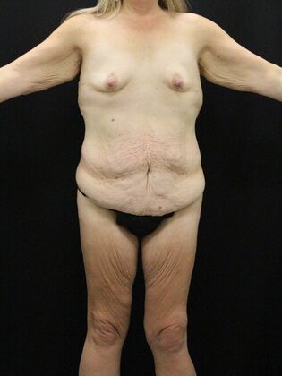 Tummy Tuck Case 32 - Before