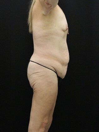 Tummy Tuck: Case 32 - Before