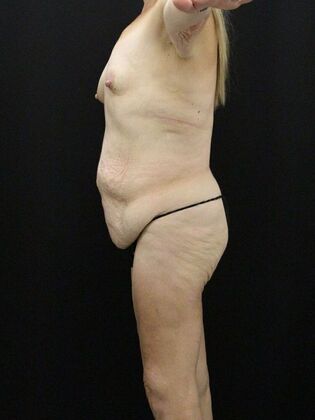 Tummy Tuck: Case 32 - Before
