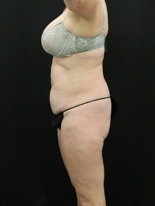 Brazilian Butt Lift: Case 9 - Before