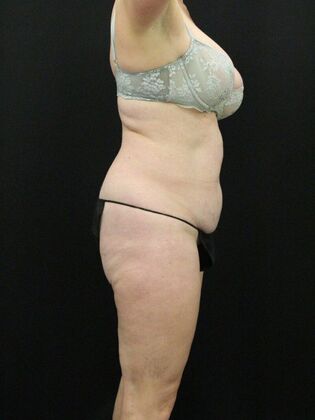 Brazilian Butt Lift: Case 9 - Before