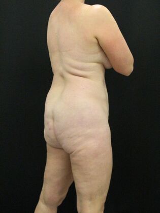 Brazilian Butt Lift: Case 9 - Before