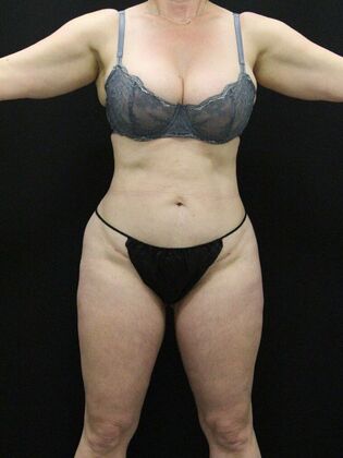 Brazilian Butt Lift: Case 9 - After