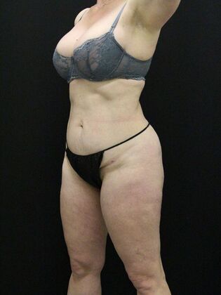 Brazilian Butt Lift: Case 9 - After