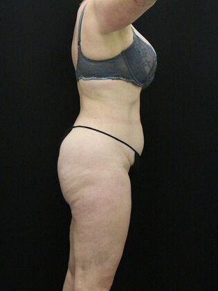 Brazilian Butt Lift: Case 9 - After